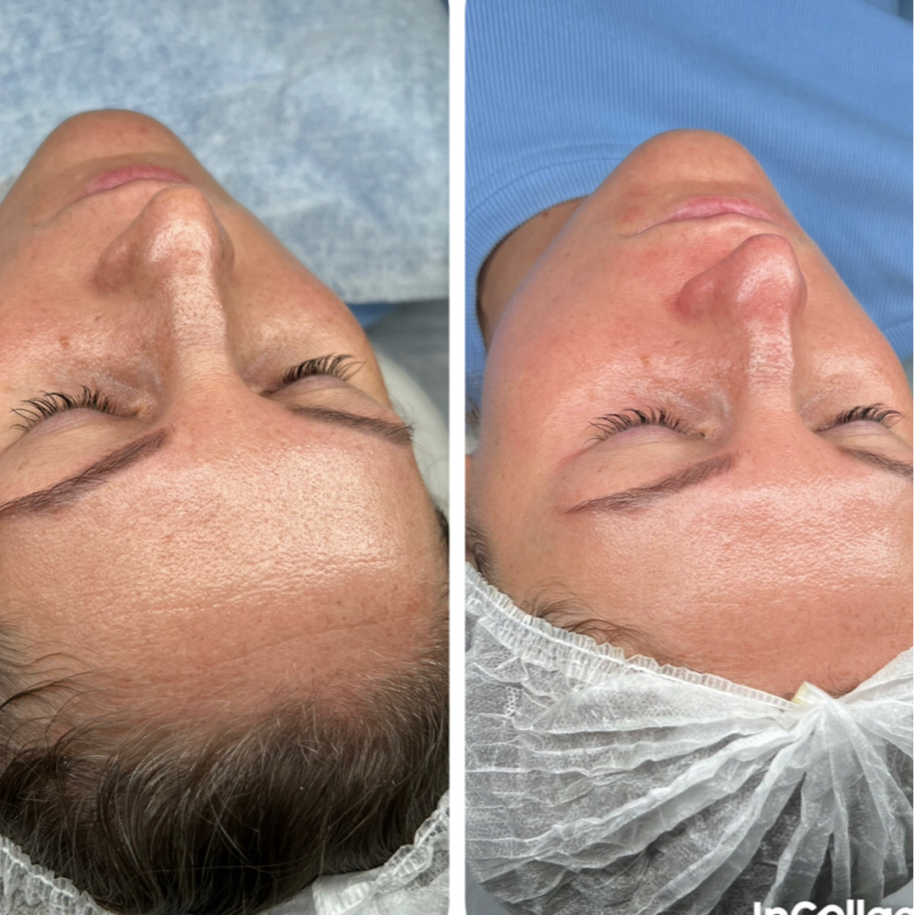 Преображение и обновление с GIGI - PMA 47 - REJUVENATING PEEL   Потеря тургора, уменьшение объёма, потеря упругости и плотности кожи, глубокие морщ