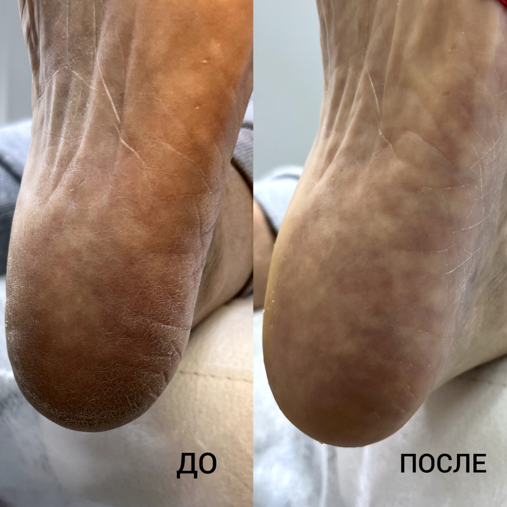 педикюр ПОДОЛОГИЧЕСКИЙ