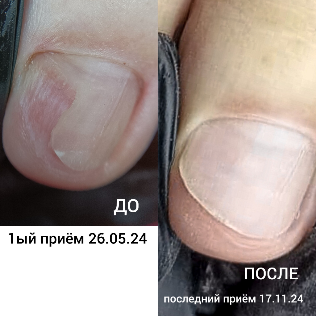 ОНИХОЛИЗИС обработка (1 ноготь) при маникюре/педикюре