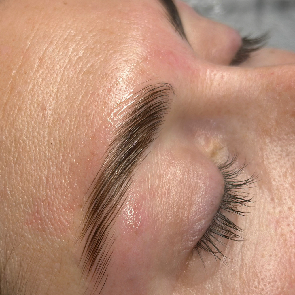 Lifting de sobranselhas