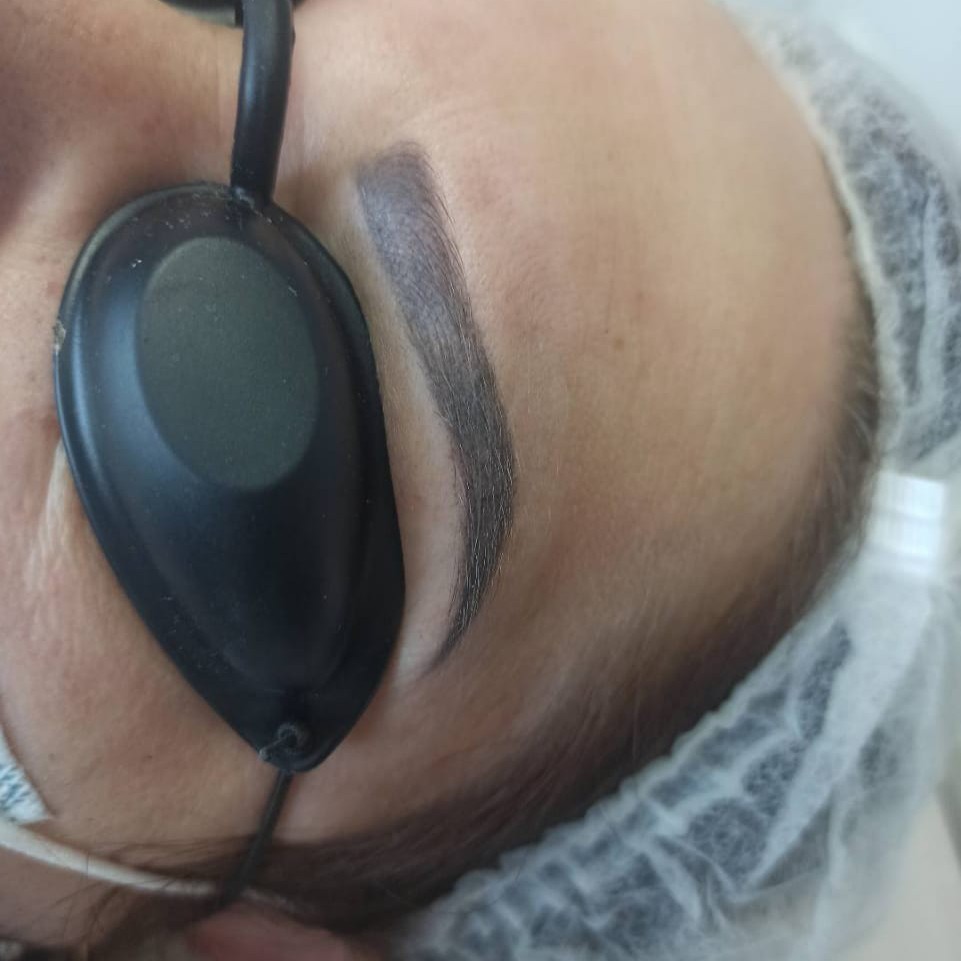 Удаления перманента/ татуировок