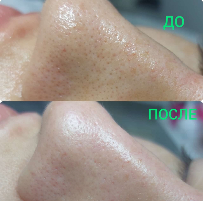 Чистка лица (ультразвуковая, механическая, комбинированная)