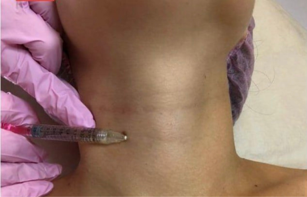 Мезотерапия шеи