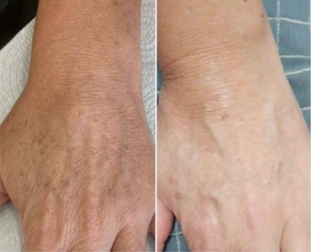 Мезотерапия кистей рук