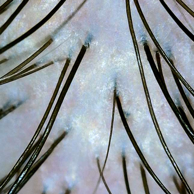 Пилинг кожи головы