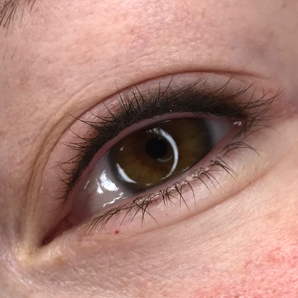 Межресничка (первичная)