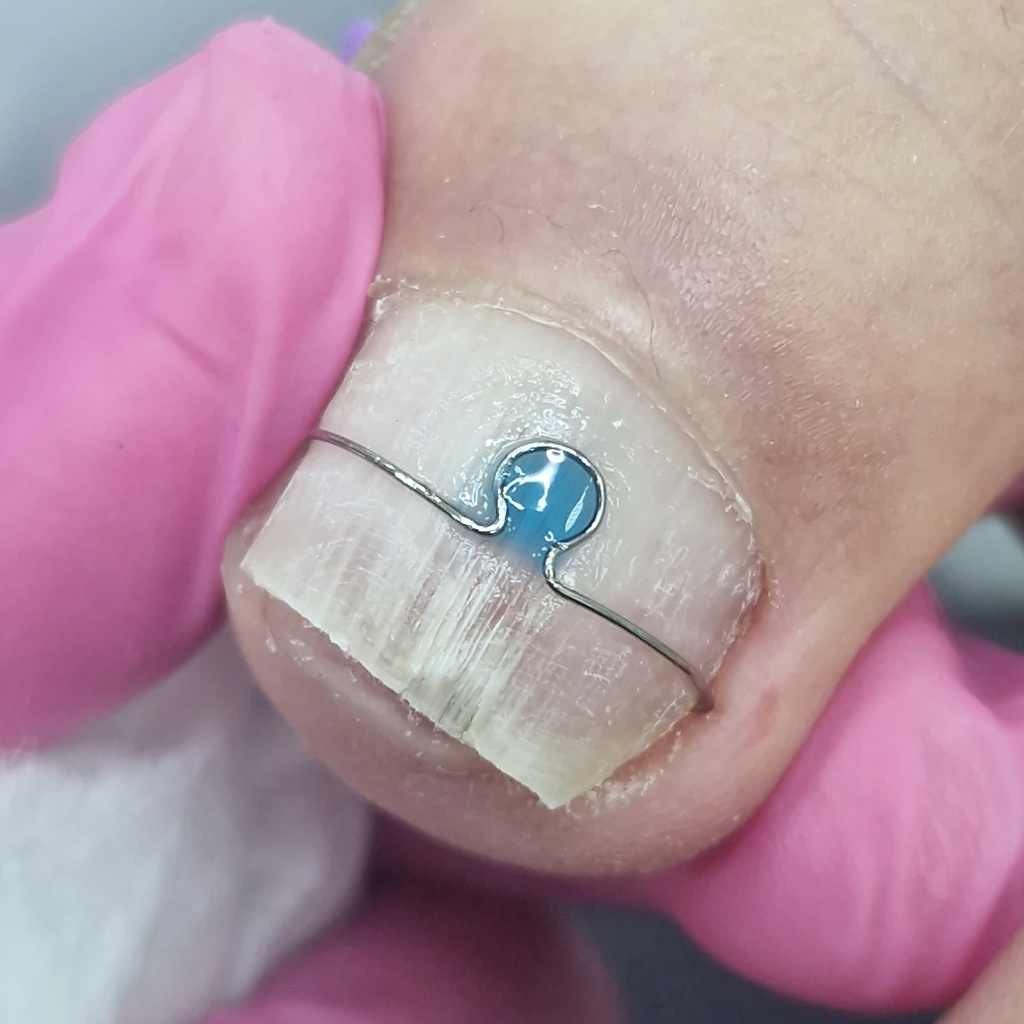 скоба Фрезера