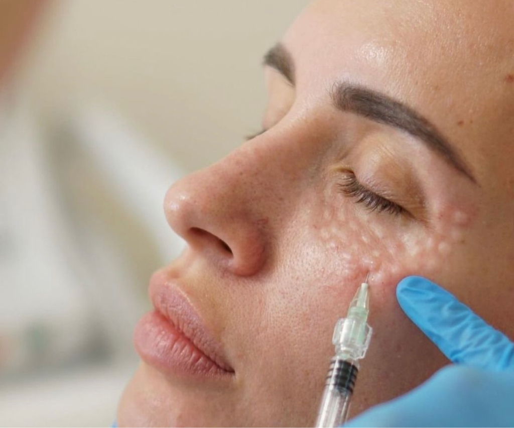 Мезотерапия области вокруг глаз