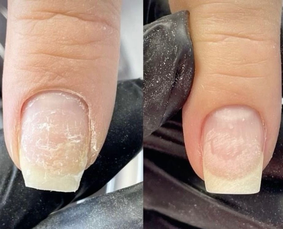 Ремонт ногтя