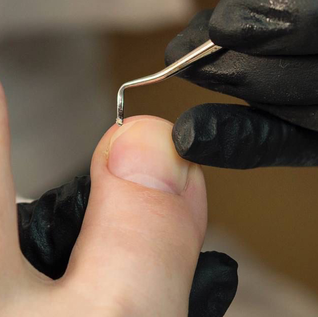 Коррекция вросшего ногтя