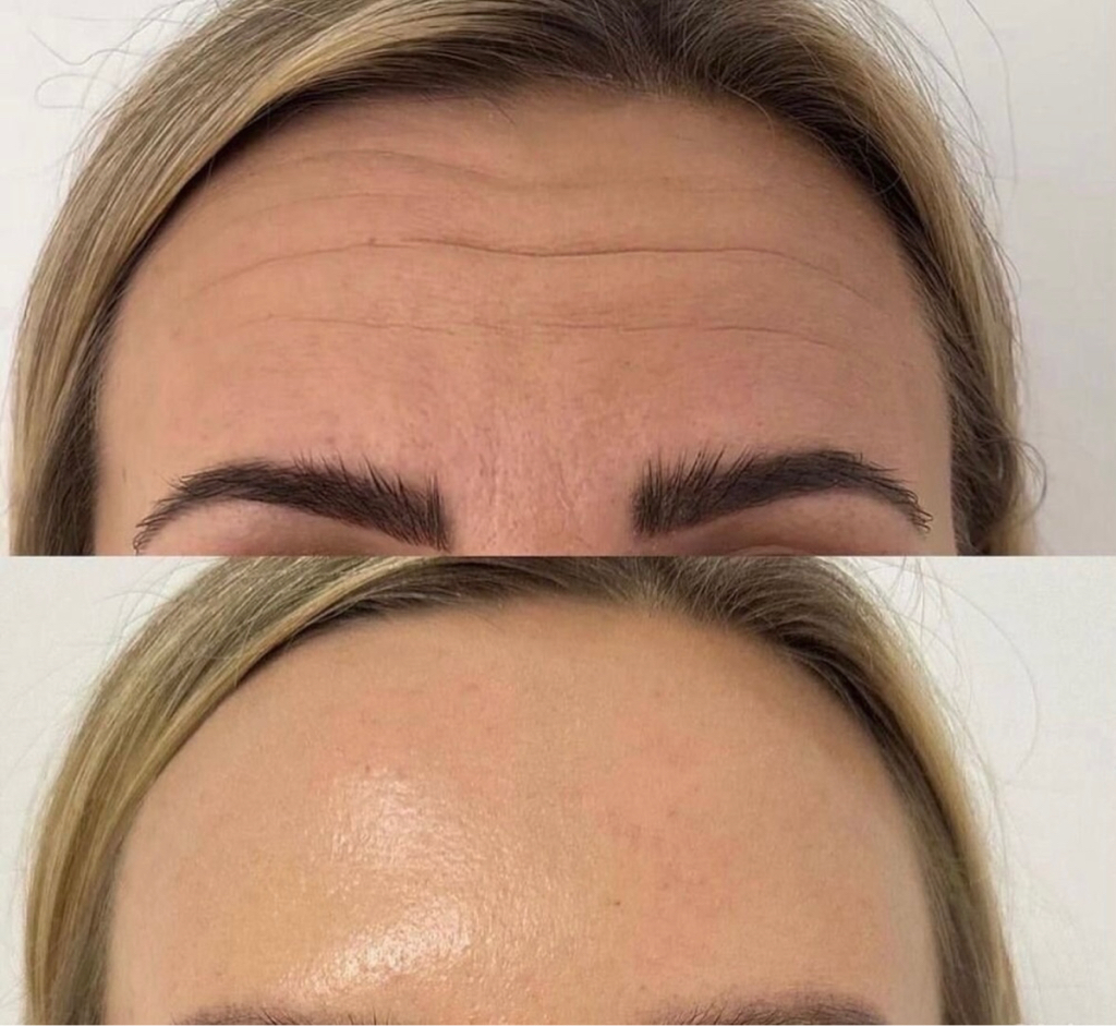 Ботулинотерапия (Релатокс )