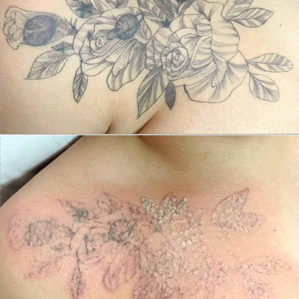 Remoção de tatuagem