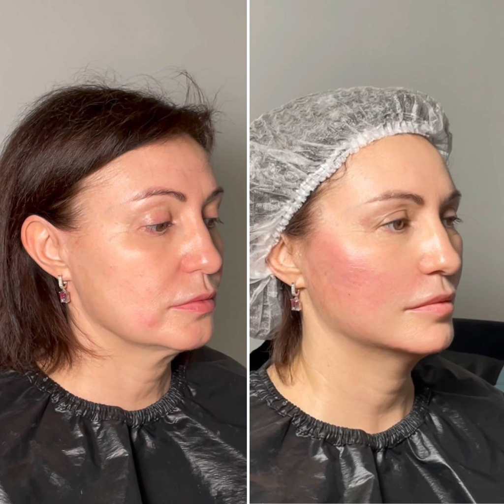 Нити с насечками