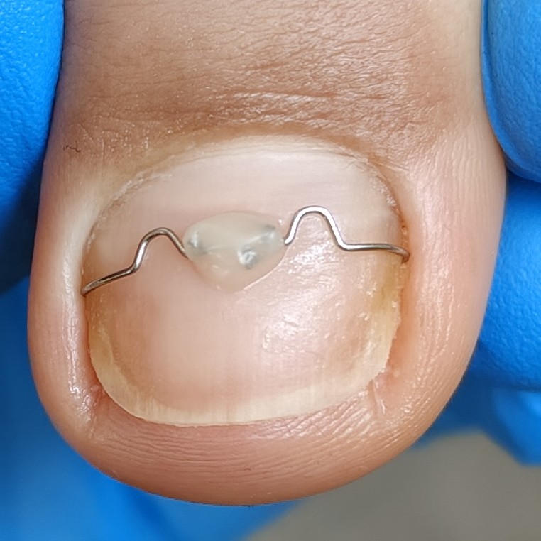 Установка скобы 3ТО