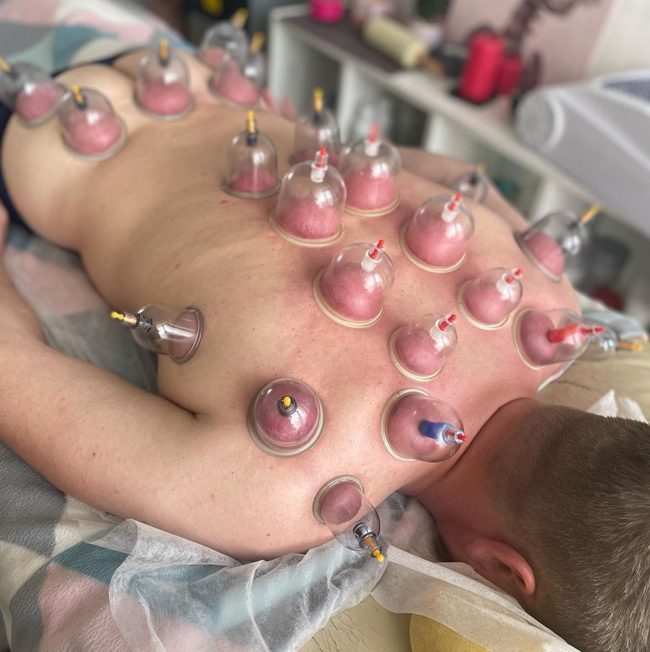 Банки. Постановка банок