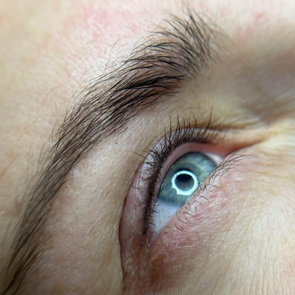 Коррекция межреснички