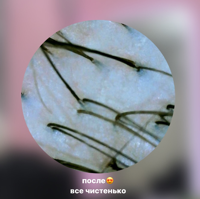 ПИЛИНГ кожи головы