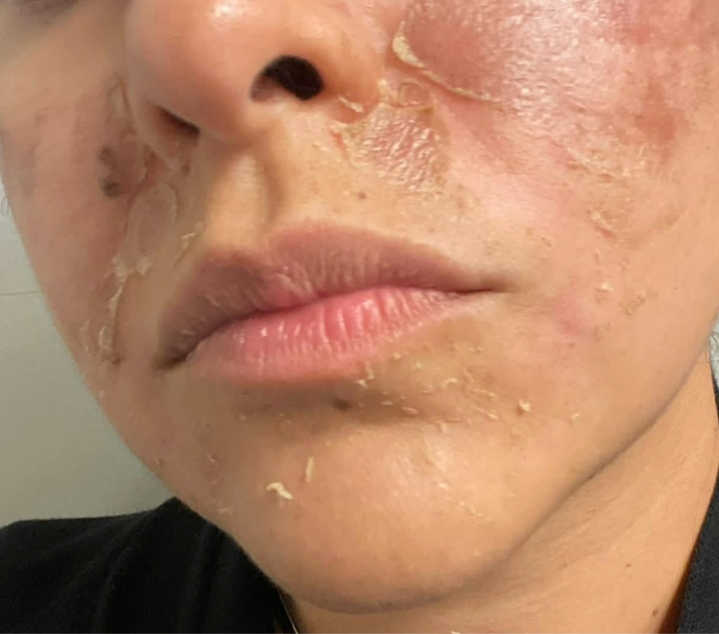 Желтый пилинг