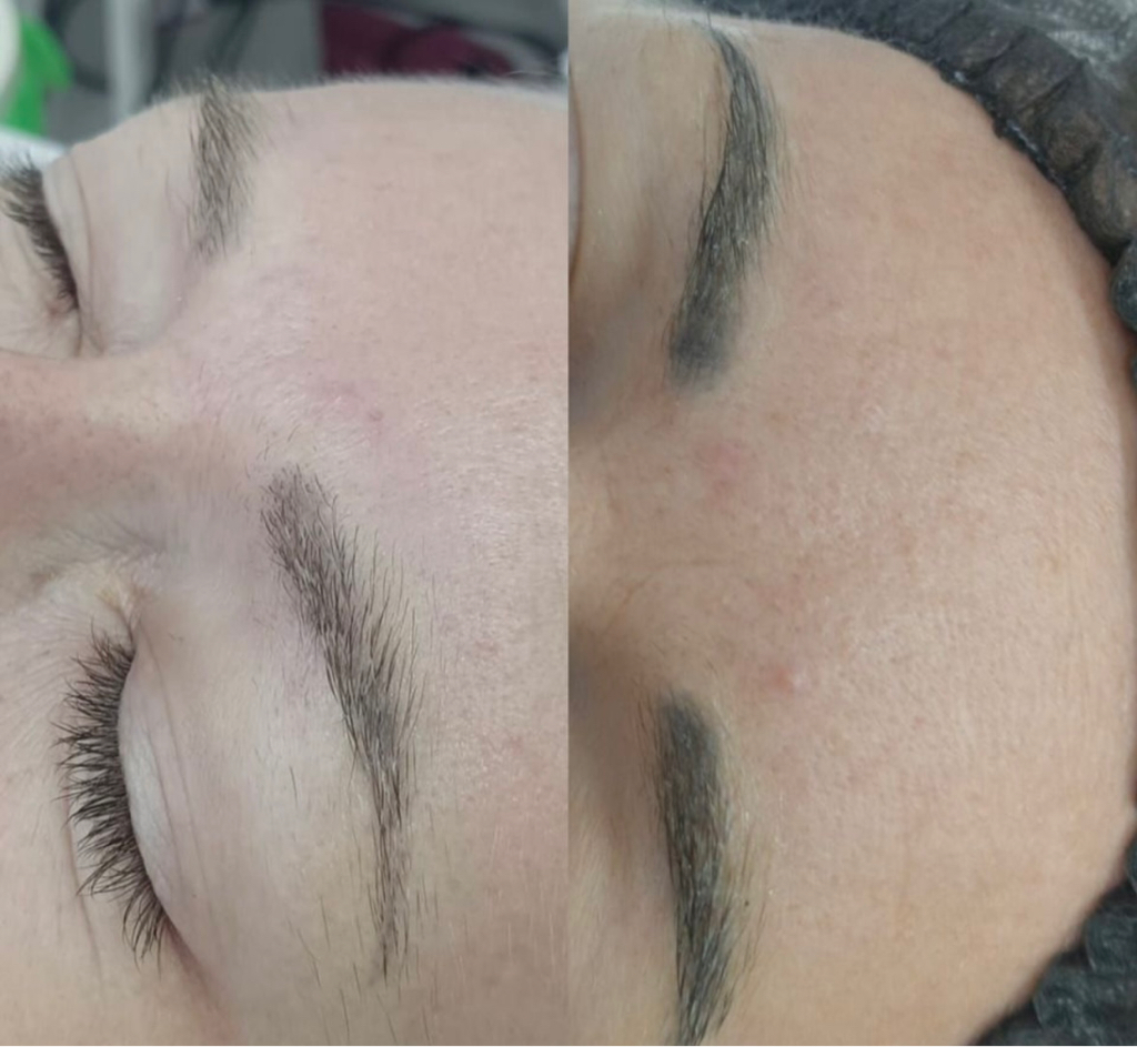 Удаление некачественного татуажа ремувером