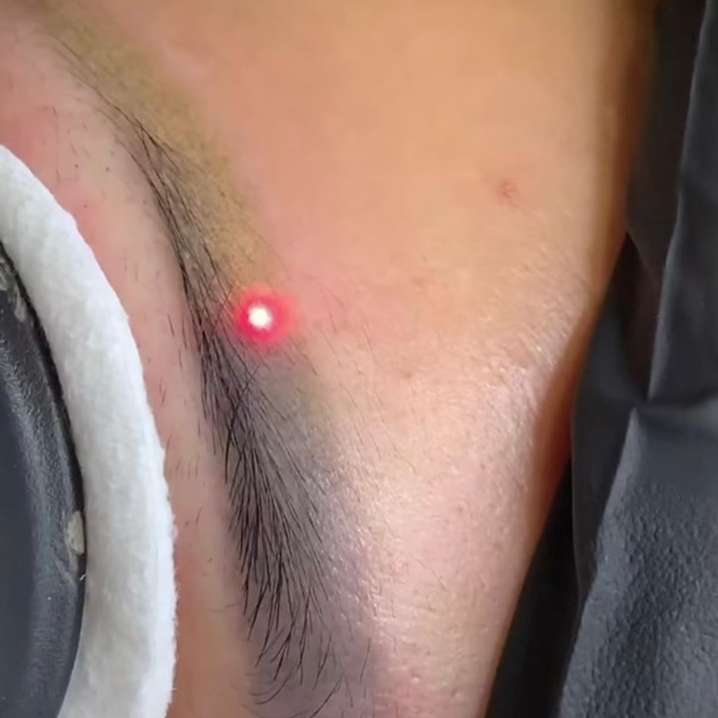 Удаление некачественного татуажа лазером