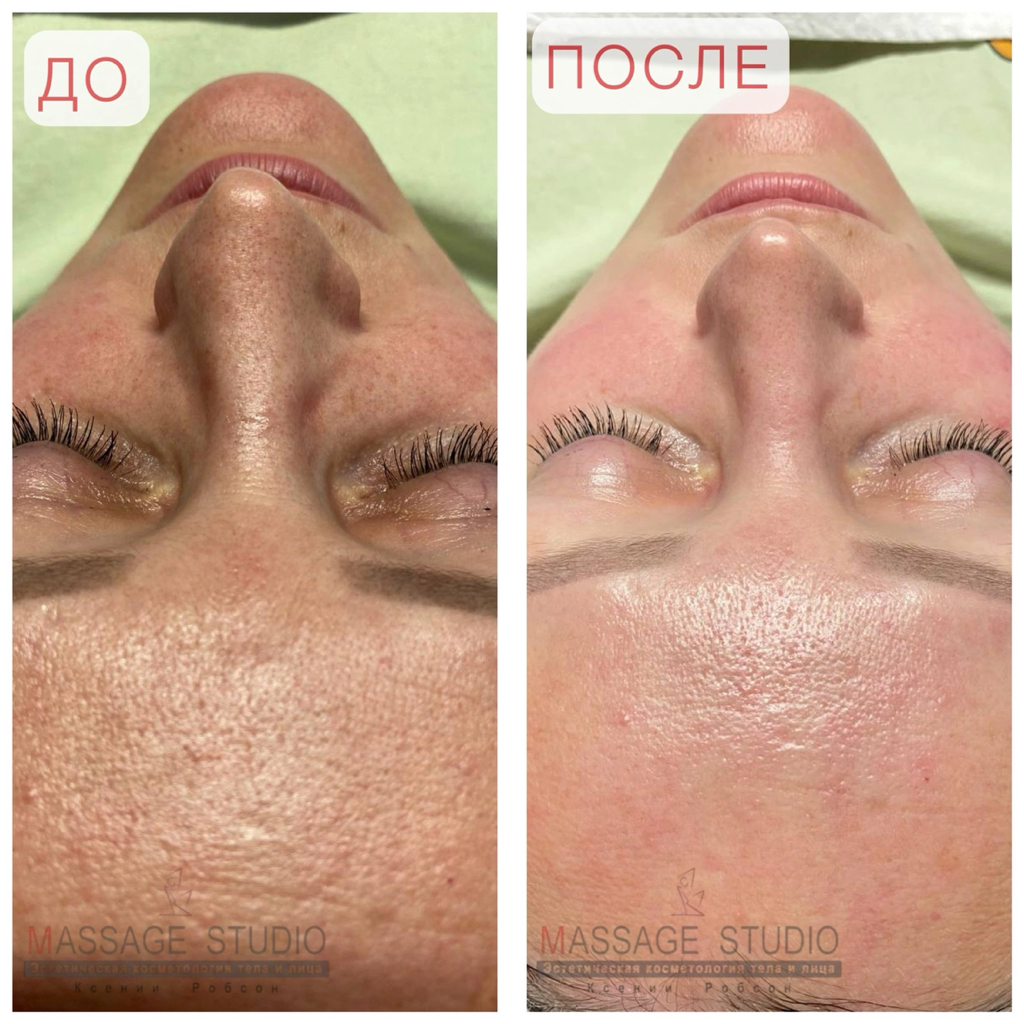 Чистка лица и антиоксидантный уход «Сияние кожи»