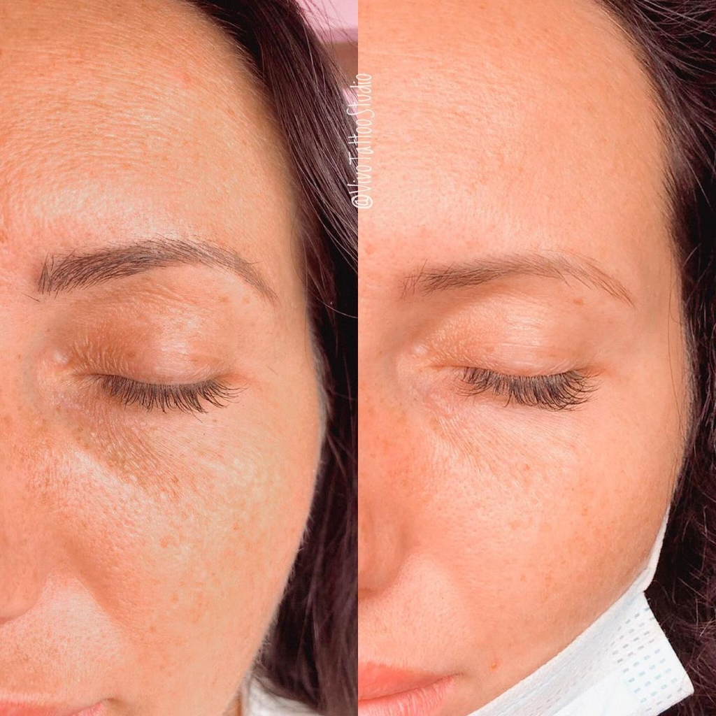 Осветление ремувером