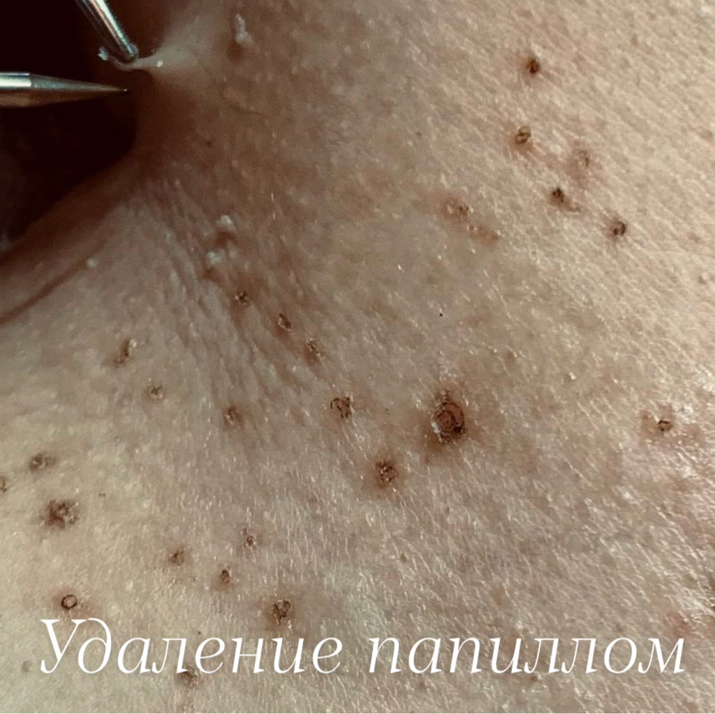 Удаление папиллом