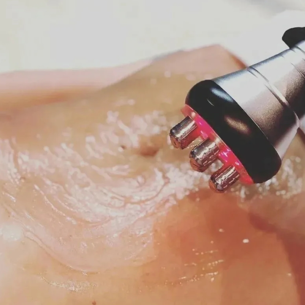 Rf лифтинг Тело (зоны «жировых ловушек»)