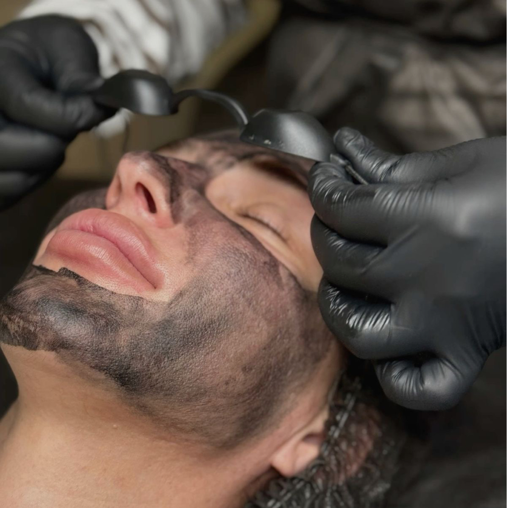 Курс 5 процедур! Лазерный карбоновый пилинг