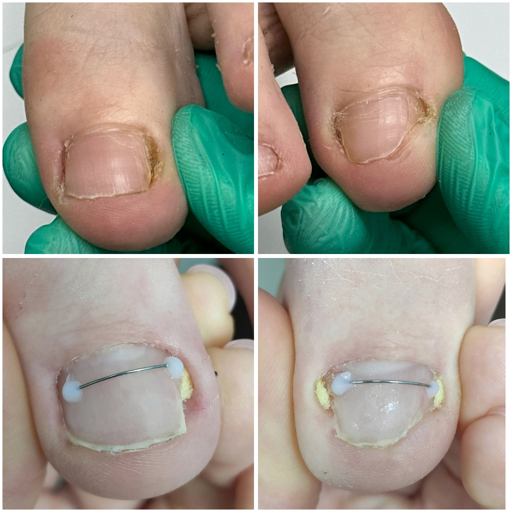 Установка коррекционной системы - 1 ноготь 