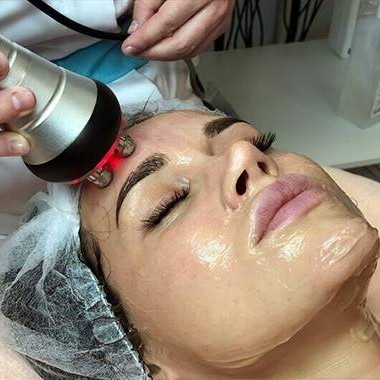 RF лифтинг лица