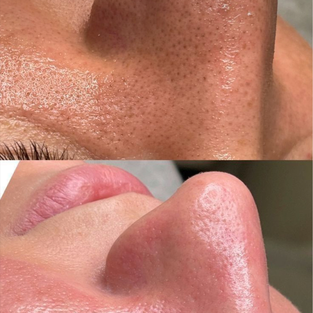 Чистка лица комбинированная