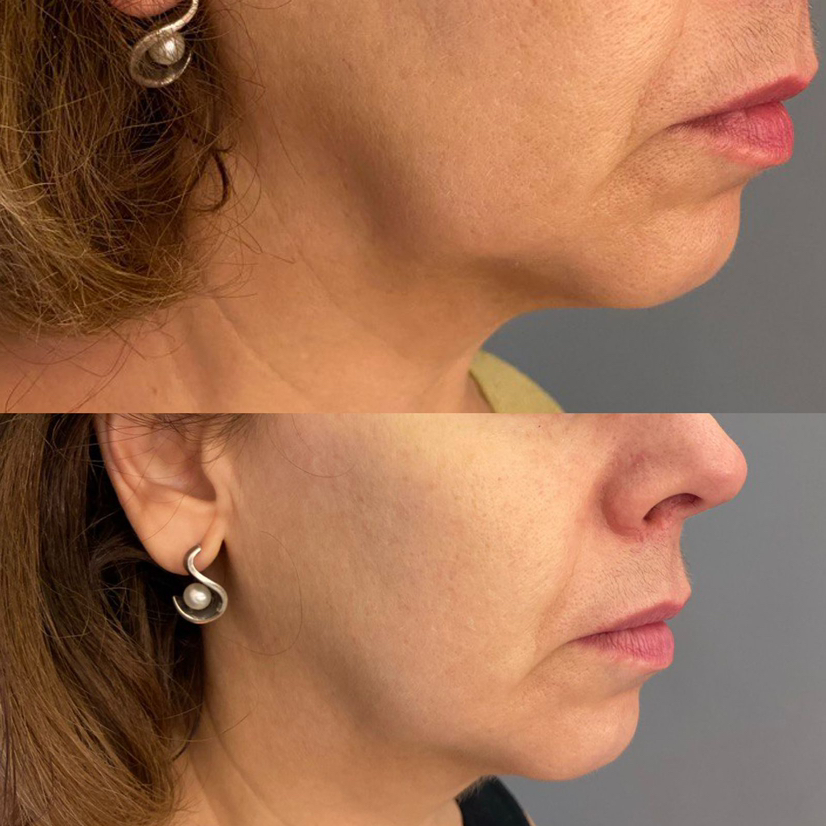 Массаж лица ПЛАСТИЧЕСКИЙ