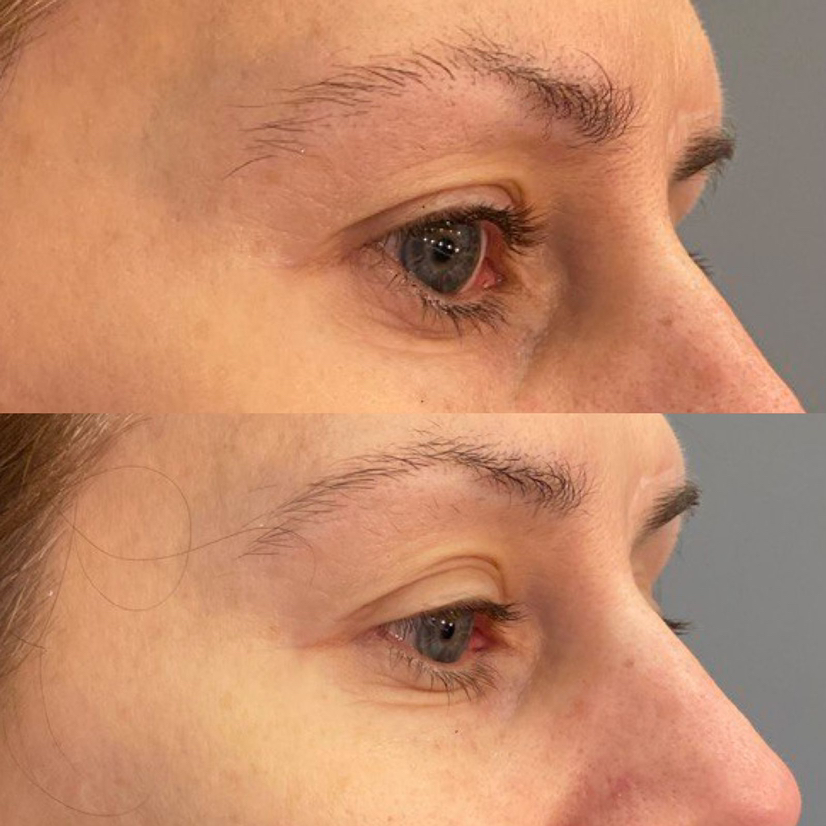 Массаж лица МИОФАСЦИАЛЬНЫЙ