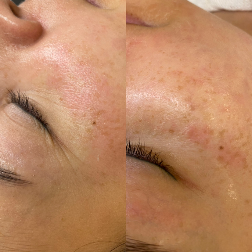 Микронидлинг лица