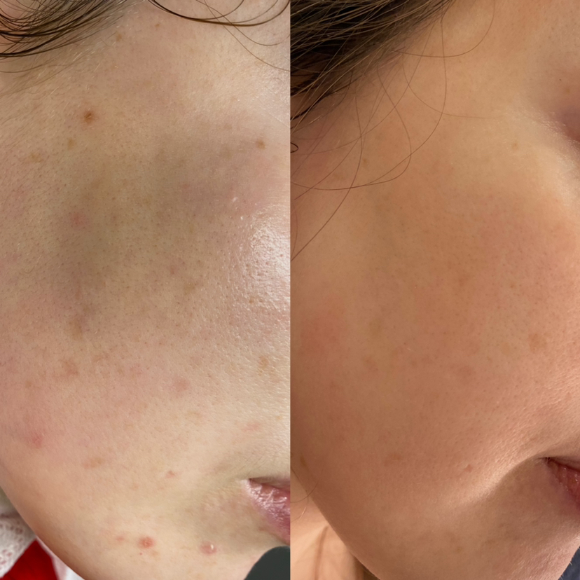 Пилинг Джесснера