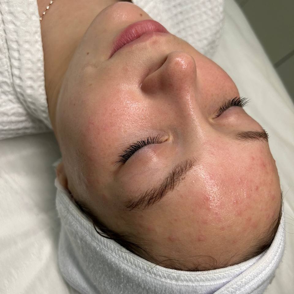 Комбинированная чистка и BioRePeelCl3 или Peach peal