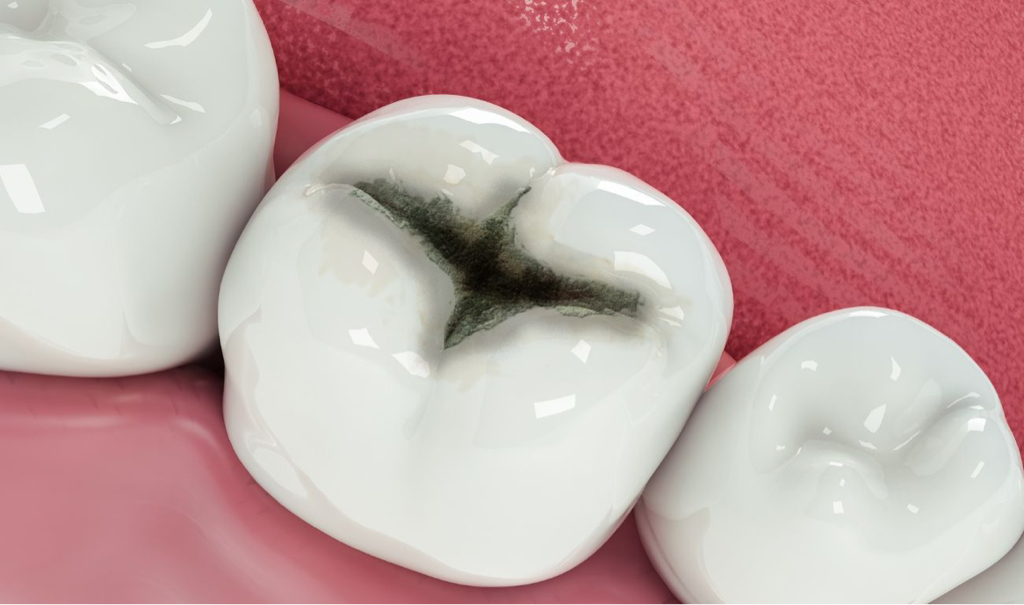 Лечение кариеса