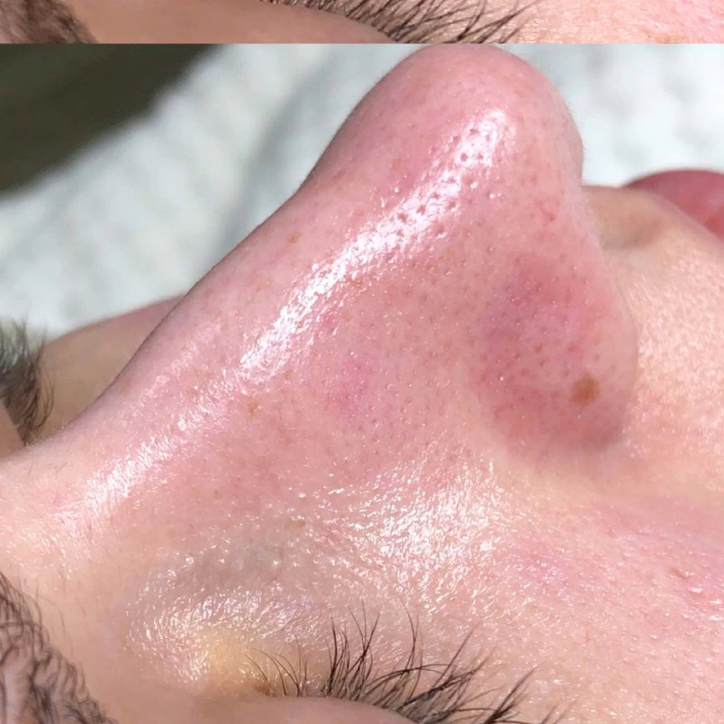 Комбинирована чистка