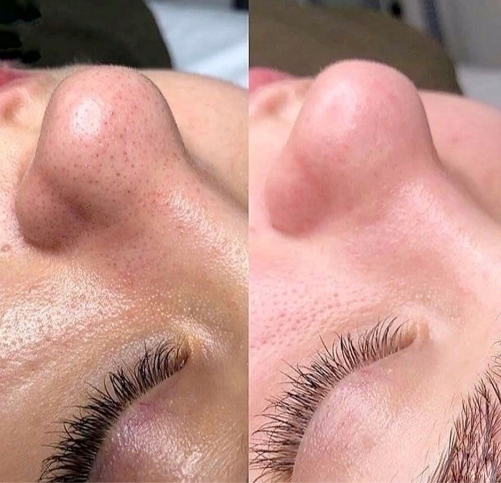 Чистка лица механическая