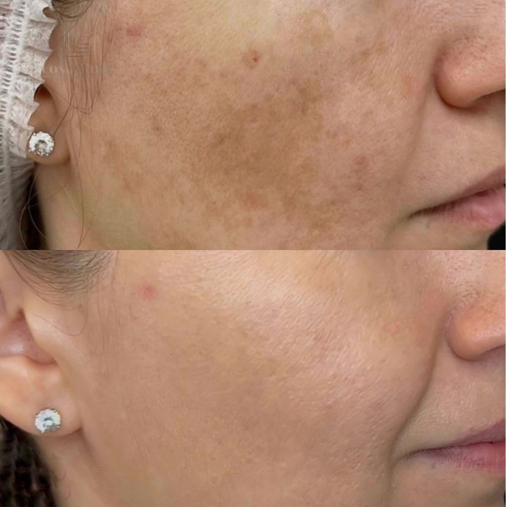 Пилинги энзимный