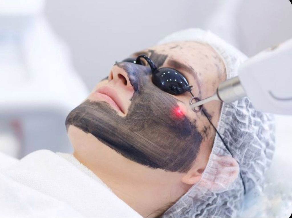 Карбоновый пилинг