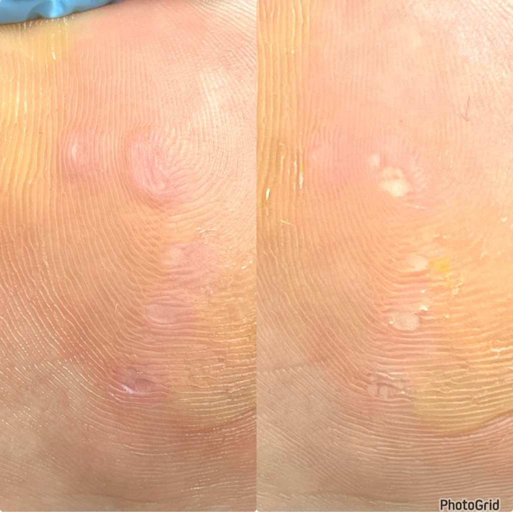 Обработка  бородавки ноги