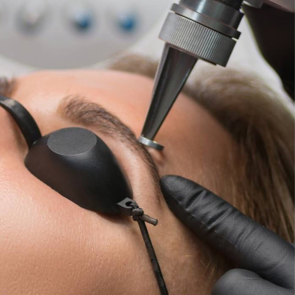 Удаление  татуажа и перманента