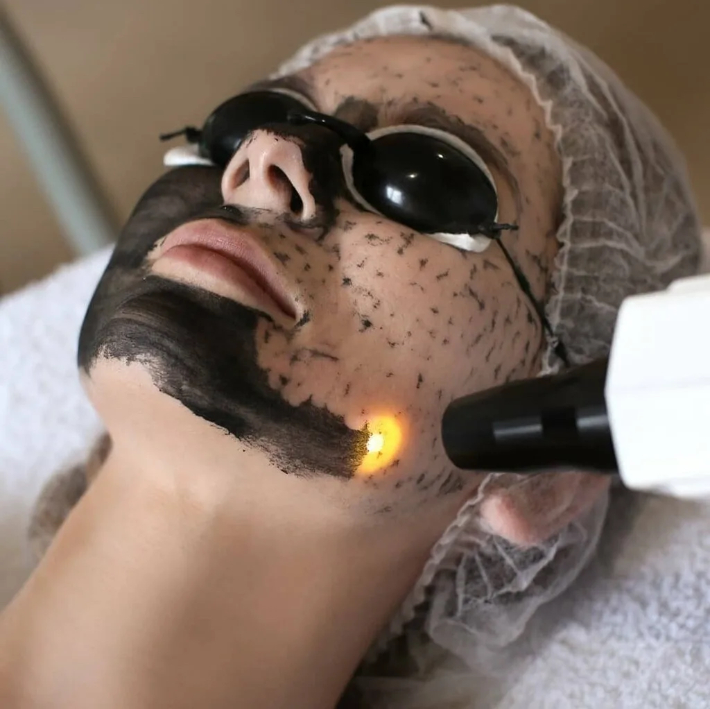 Лазерный карбоновый  пилинг