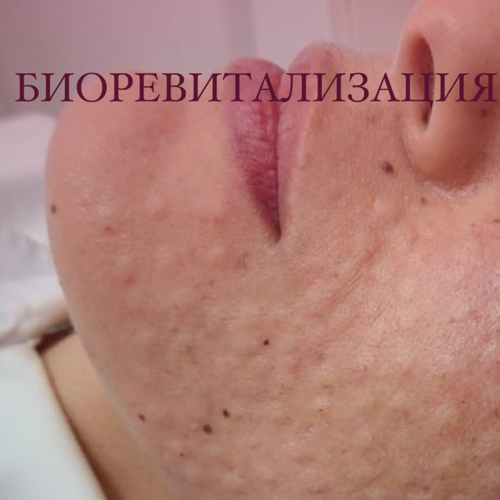 Биоревитализация