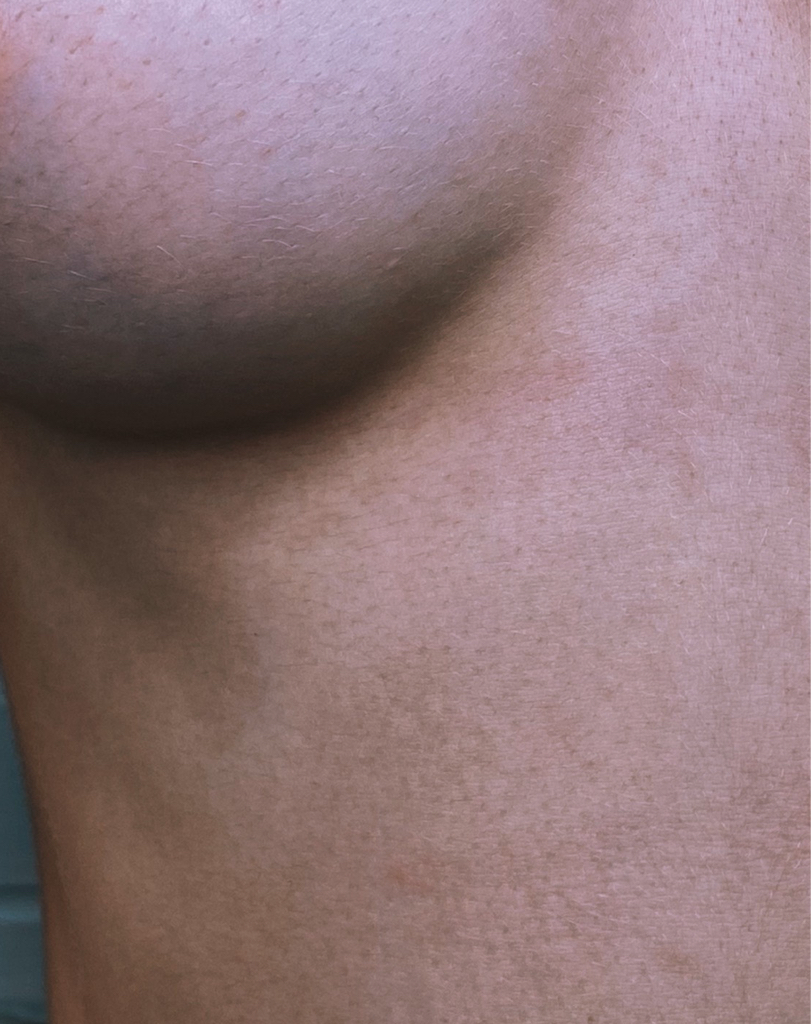 Прокол соска