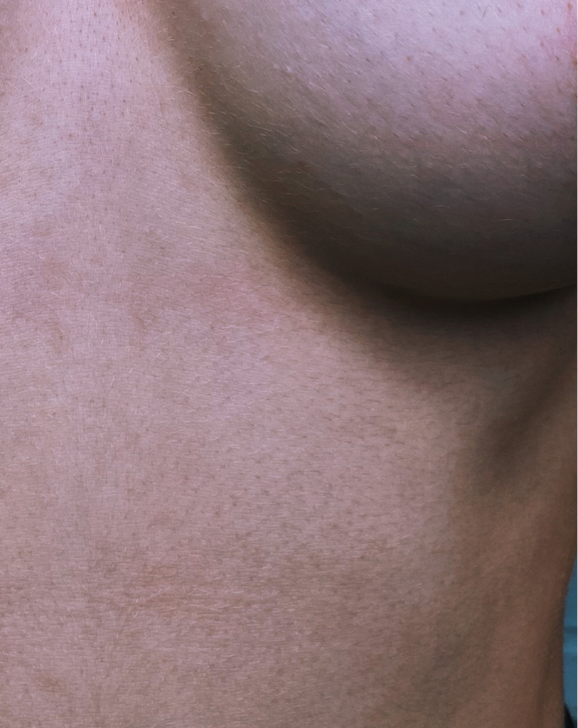 Прокол двух сосков