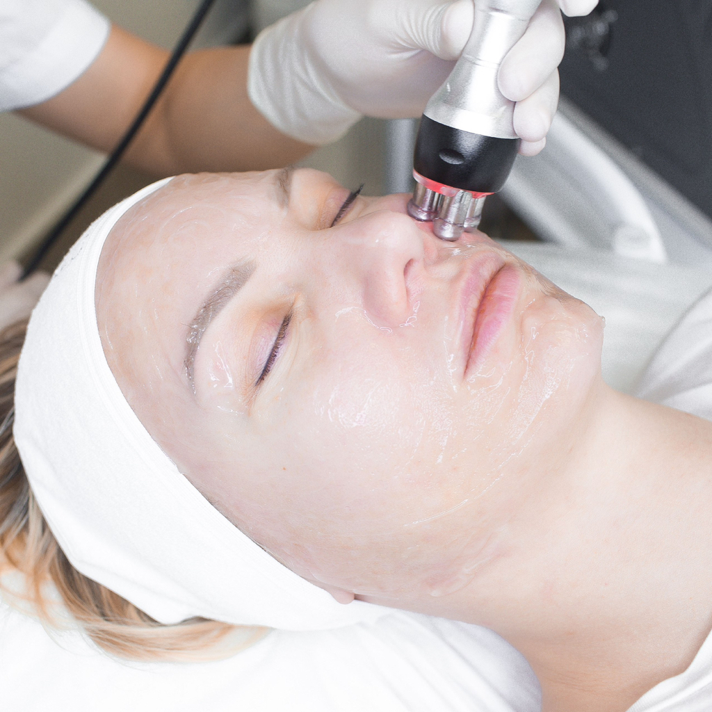 RF лифтинг лица