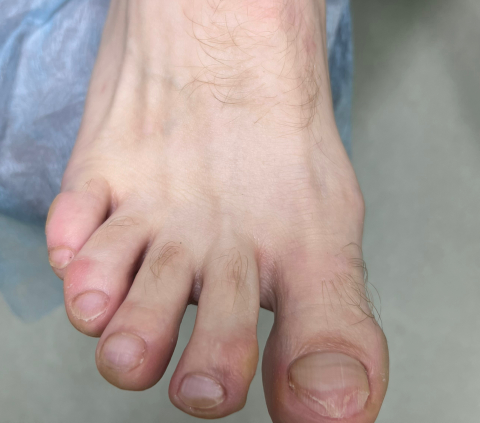 Подологический педикюр